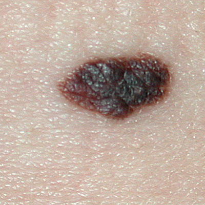 Skin Cancer Algorithm for Diagnosis - Melanoma - Image 6