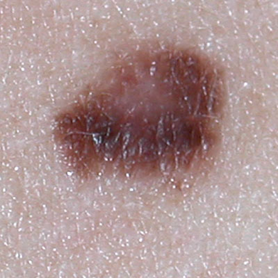 Skin Cancer Algorithm for Diagnosis - Melanoma - Image 7
