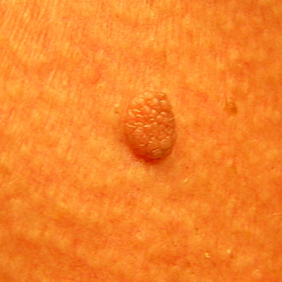 Skin Cancer Algorithm for Diagnosis - Mole - Image 2