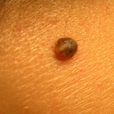 Skin Cancer Algorithm for Diagnosis - Mole - Image 6