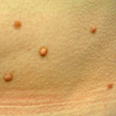 Skin Cancer Algorithm for Diagnosis - Mole - Image 7