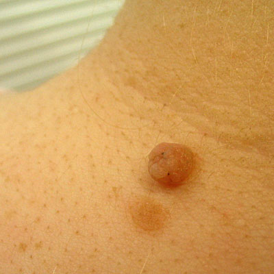 Skin Cancer Algorithm for Diagnosis - Mole - Image 8