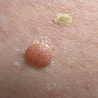 age spots vs skin cancer | Lifescript.com
