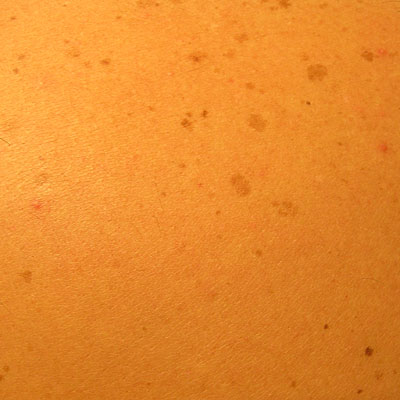Skin Cancer Algorithm for Diagnosis - Seborrhoeic Keratosis - Image 6
