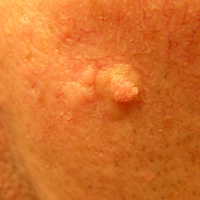 Skin Cancer Algorithm for Diagnosis - Seborrhoeic Keratosis - Image 9