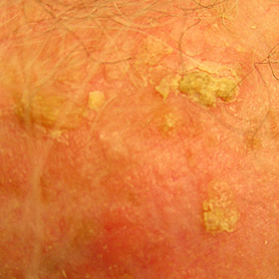 Skin Cancer Algorithm for Diagnosis - Actinic Keratosis - Image 5