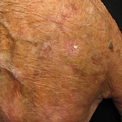 Skin Cancer Algorithm for Diagnosis - Actinic Keratosis - Image 6