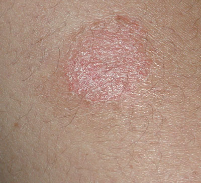 Skin Cancer Algorithm for Diagnosis - Discoid Eczema - Image 1