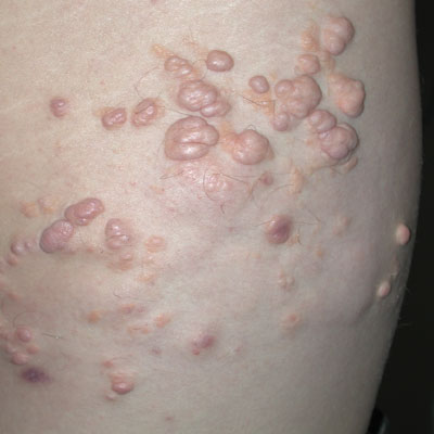 Pictures of Skin Diseases and Problems - Neurofibromatosis