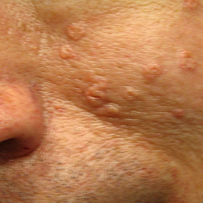 Skin Cancer Algorithm for Diagnosis - Sebaceous Hyperplasia - Image 3