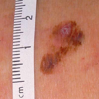 images of melanoma