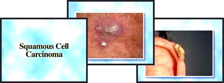 Squamous Cell Cancer Video