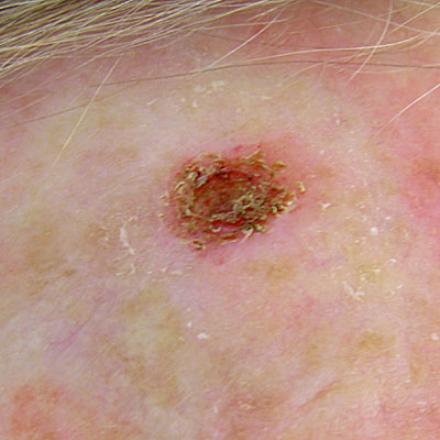Skin Cancer Algorithm for Diagnosis - Nodular BCC - Image 14