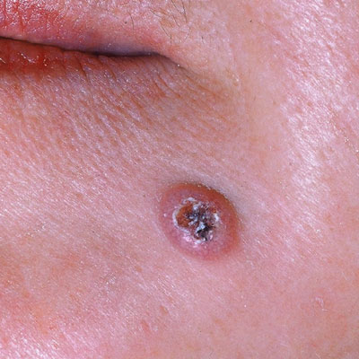 Picture of Basal Cell Carcinoma: Advanced Nodular BCC