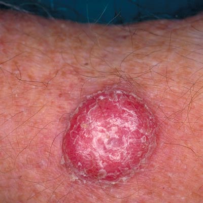 Squamous Cell Cancer - Image 1