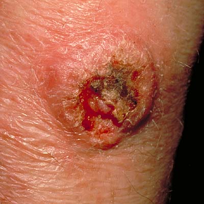 Squamous Cell Cancer - Image 3