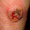 Squamous Cell Cancer: Image 3