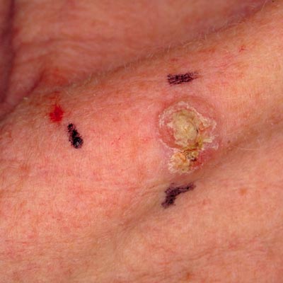 Squamous Cell Cancer - Image 7