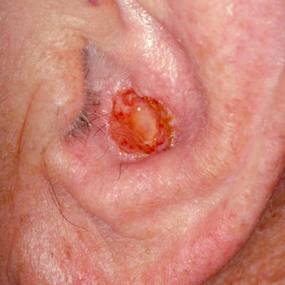 Squamous Cell Cancer - Image 8