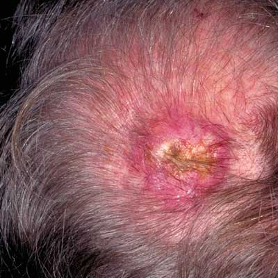 Squamous Cell Cancer - Image 9