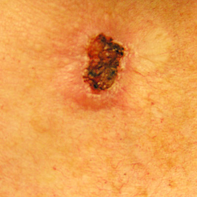 Skin Cancer Algorithm for Diagnosis - Sclerotic BCC - Image 1